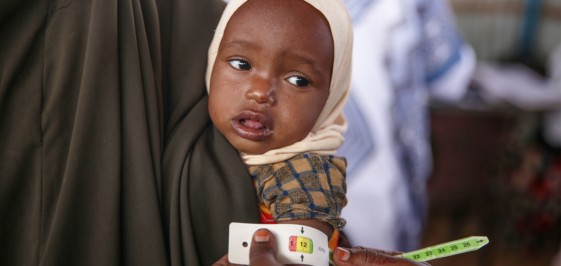 A Somalian Child Is Measured For Stunting, A Consequence Of Chronic Malnourishment